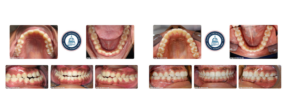before and after